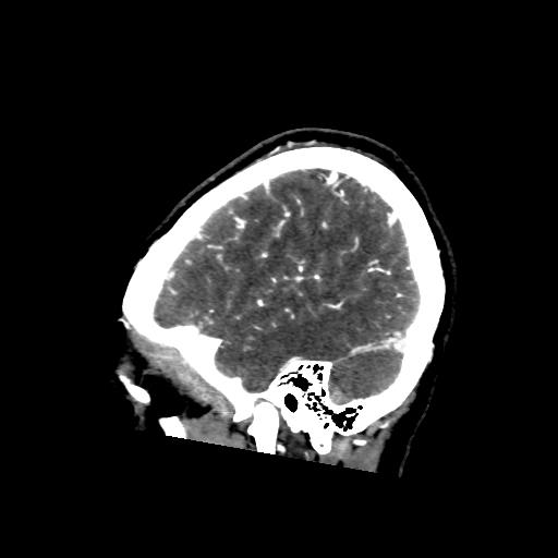 File:Cerebral venous thrombosis - hemorrhagic venous infarction (Radiopaedia 87318-103613 Sagittal 38).jpg