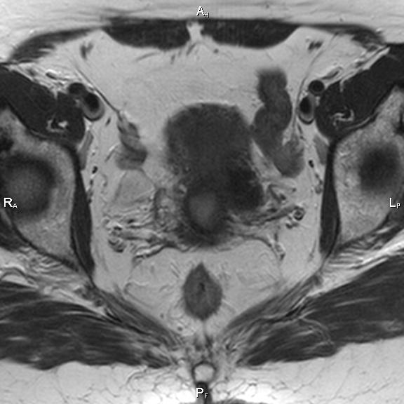 File:Cervical adenocarcinoma (Radiopaedia 65011-73985 Axial T2 21).jpg