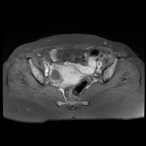 File:Cervical carcinoma (Radiopaedia 88010-104555 Axial T1 C+ fat sat 10).jpg
