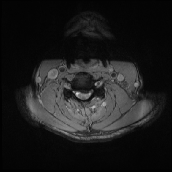File:Cervical disc extrusion (Radiopaedia 53950-60077 Axial T2 17).jpg