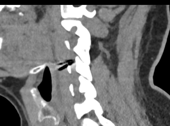File:Cervical disc replacement (Radiopaedia 44025-47541 B 38).png