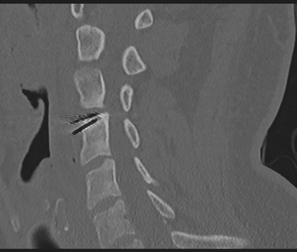 Cervical disc replacement (Radiopaedia 44025-47541 Sagittal bone window 37).png