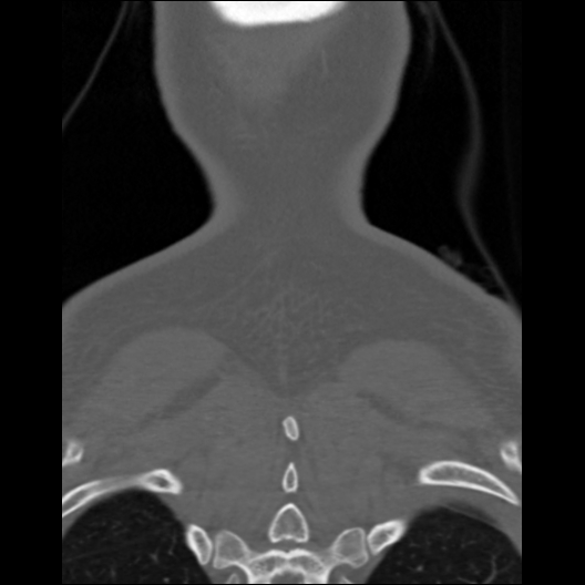 File:Cervical rib (Radiopaedia 71110-81363 Coronal non-contrast 7).jpg