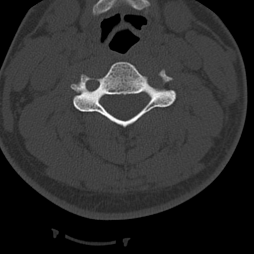 File:Cervical schwannoma (Radiopaedia 57979-64974 Axial bone window 24).png