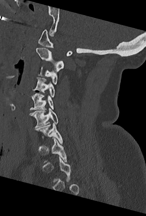 Cervical spine ACDF loosening (Radiopaedia 48998-54070 Sagittal bone window 36).png