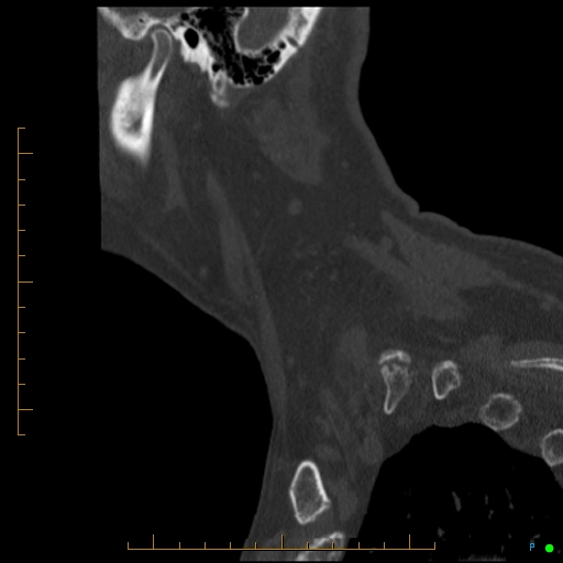 Cervical spine fracture - ankylosing spondylitis (Radiopaedia 76835-88706 Sagittal bone window 12).jpg