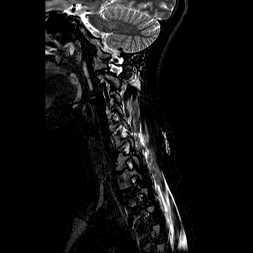File:Cervical spine posterior ligamentous complex rupture (Radiopaedia 63486-72103 Sagittal STIR 3).jpg