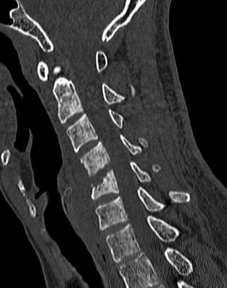Cervical spondylodiscitis (Radiopaedia 28057-29489 Sagittal bone window 37).jpg