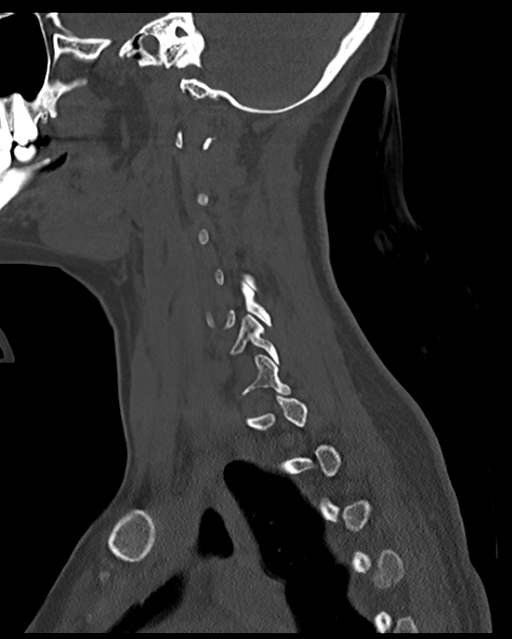 Cervical tuberculous spondylitis (Radiopaedia 39149-41365 Sagittal bone window 20).png