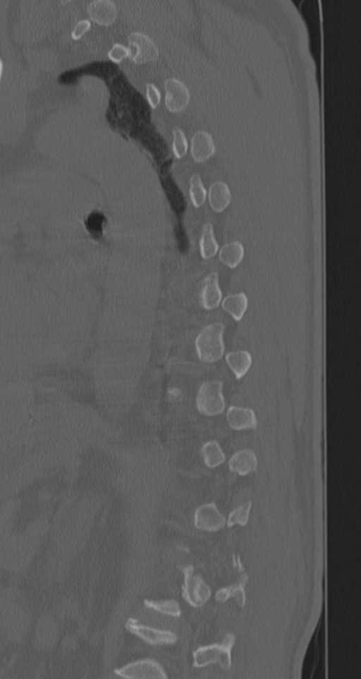 Chance fracture (Radiopaedia 33854-35020 Sagittal bone window 28).png