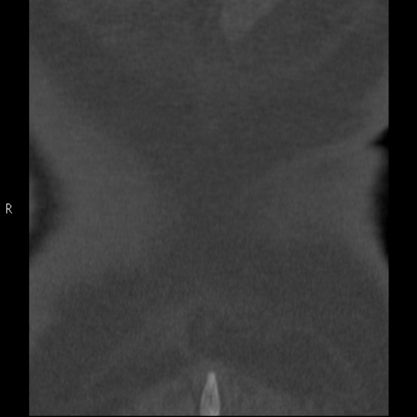 File:Chance fracture (Radiopaedia 36521-38081 Coronal bone window 74).jpg