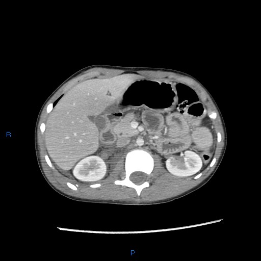 File:Chance fracture with duodenal and pancreatic lacerations (Radiopaedia 43477-46864 A 9).jpg
