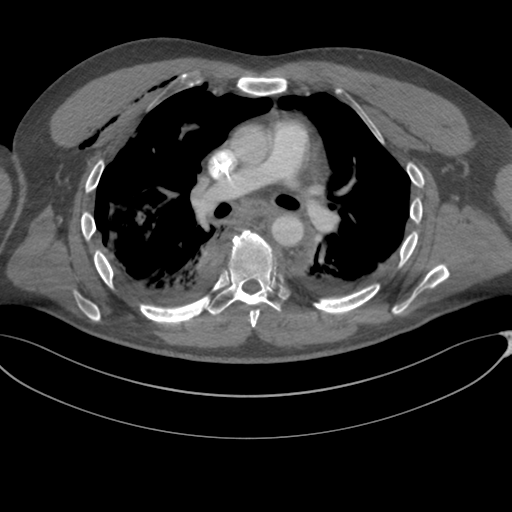 File:Chest multitrauma - aortic injury (Radiopaedia 34708-36147 A 134).png