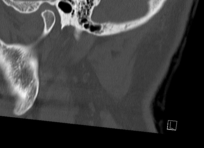 Chiari I malformation with a symptomatic syrinx of the posterolateral medulla oblongata (Radiopaedia 42573-45707 A 55).jpg