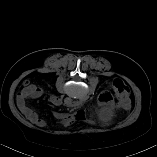 File:Cholecystitis - obstructive choledocholitiasis (CT intravenous cholangiography) (Radiopaedia 43966-47479 Axial 64).png