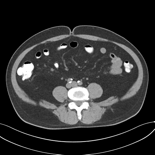Cholecystitis with focal perforation and hepatic abscess (Radiopaedia 37189-38945 Axial non-contrast 53).png