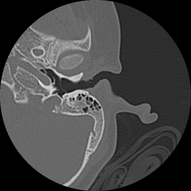 Cholesteatoma (Radiopaedia 73023-83750 Axial Left ear 21).jpg