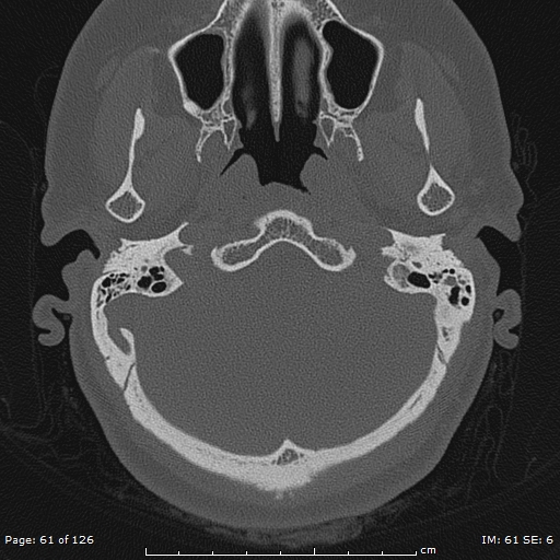 Cholesteatoma - external auditory canal (Radiopaedia 88452-105096 Axial bone window 24).jpg