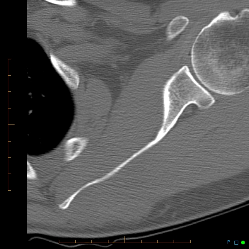 File:Chondrosarcoma of the scapula (Radiopaedia 30696-31399 Axial non-contrast 2).jpg