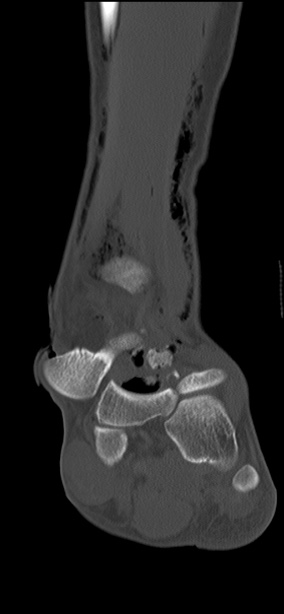 Chopart fracture (Radiopaedia 35347-36851 Coronal bone window 42).jpg