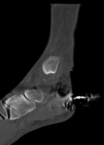 Chopart fracture (Radiopaedia 35347-36861 Sagittal bone window 30).jpg