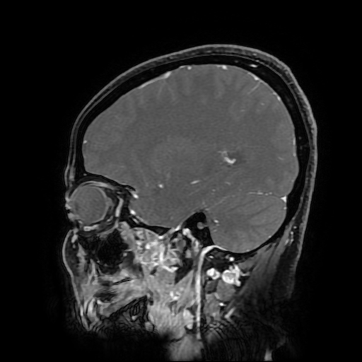 Chordoid glioma of third ventricle (Radiopaedia 91612-109340 F 143).jpg