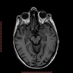 Choroid plexus xanthogranuloma (Radiopaedia 67843-77270 Axial T1 101).jpg