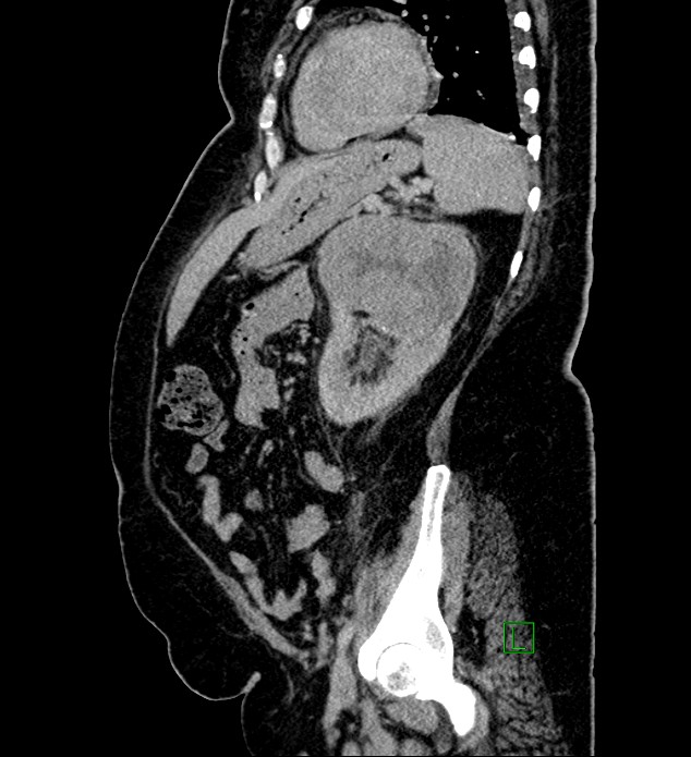 Chromophobe renal cell carcinoma (Radiopaedia 84239-99519 G 38).jpg