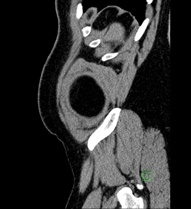 Chromophobe renal cell carcinoma (Radiopaedia 84286-99573 C 4).jpg