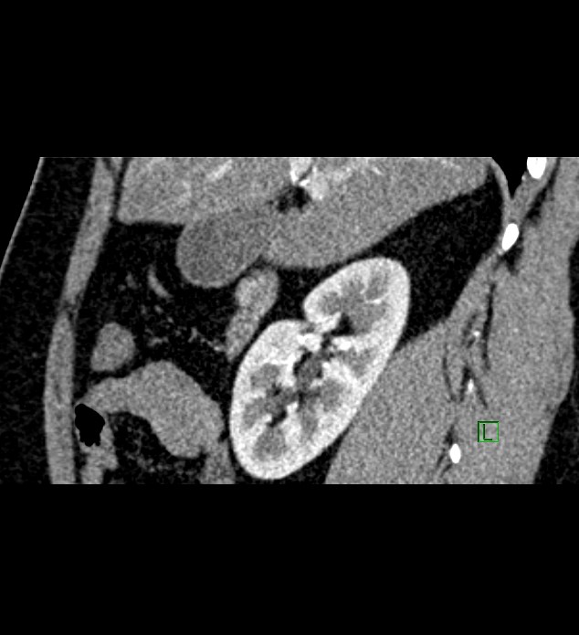 Chromophobe renal cell carcinoma (Radiopaedia 84286-99573 F 116).jpg