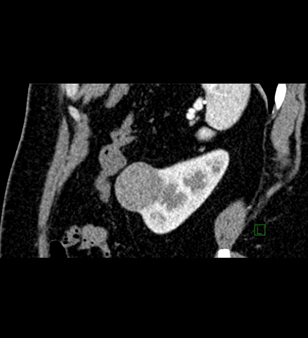 Chromophobe renal cell carcinoma (Radiopaedia 84286-99573 F 32).jpg