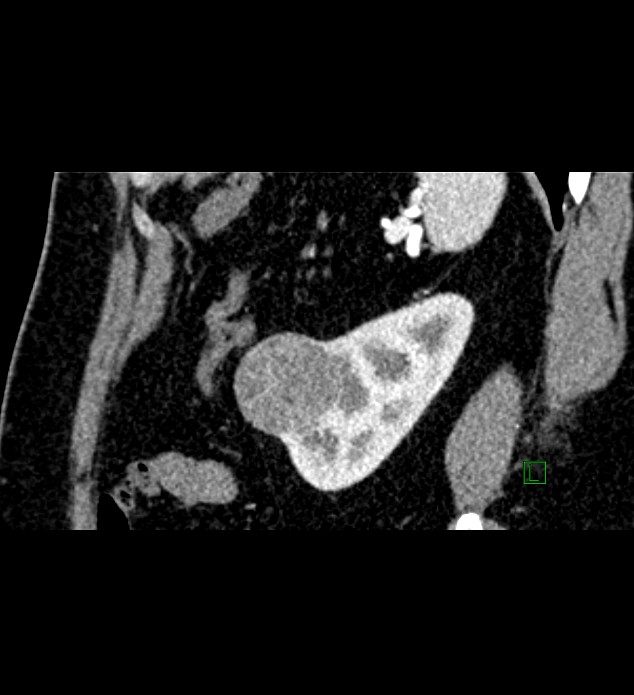Chromophobe renal cell carcinoma (Radiopaedia 84286-99573 F 36).jpg