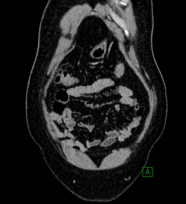 Chromophobe renal cell carcinoma (Radiopaedia 84286-99573 H 29).jpg