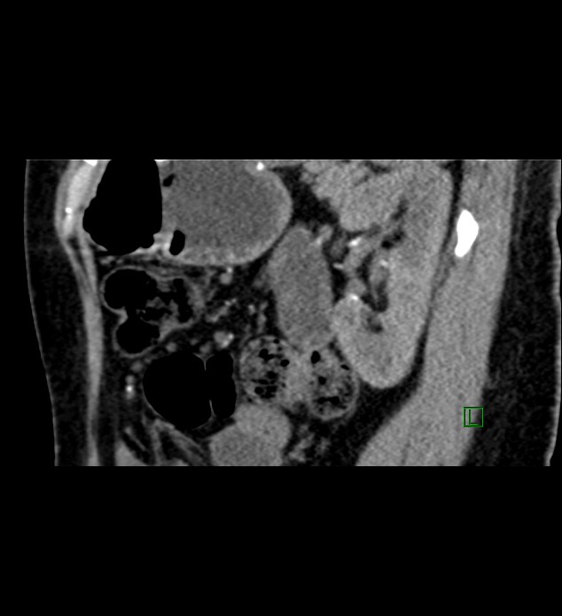 Chromophobe renal cell carcinoma (Radiopaedia 84290-99582 D 30).jpg