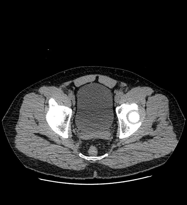 Chromophobe renal cell carcinoma (Radiopaedia 84337-99693 Axial non-contrast 147).jpg