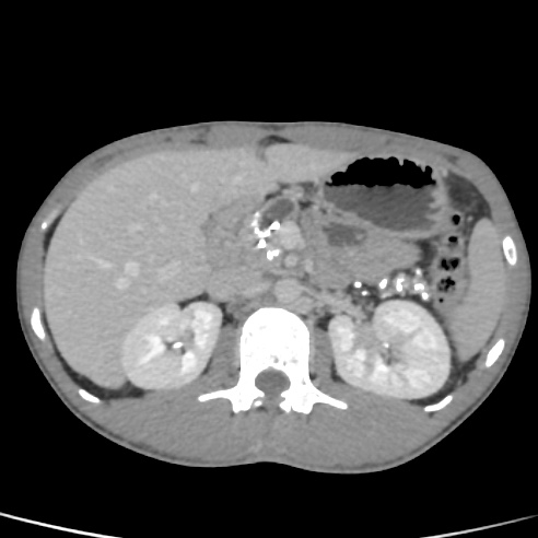 File:Chronic calcific pancreatitis (Radiopaedia 56280-62953 C 15).jpg