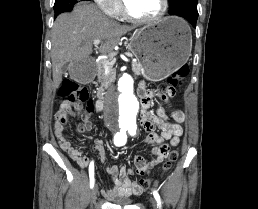 File:Chronic contained rupture of abdominal aortic aneurysm with extensive erosion of the vertebral bodies (Radiopaedia 55450-61901 D 21).jpg