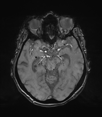 Chronic hypertensive encephalopathy (Radiopaedia 72844-83495 Axial SWI magnitude 33).png