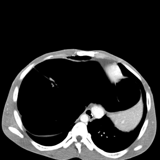 Chronic large bowel pseudo-obstruction (Radiopaedia 43181-46492 A 32).jpg