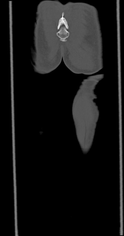 Chronic osteomyelitis (with sequestrum) (Radiopaedia 74813-85822 Coronal non-contrast 55).jpg