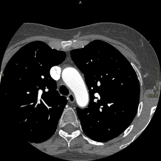 Chronic pulmonary embolism (Radiopaedia 73073-85094 Axial C+ CTPA 26).jpg