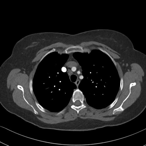 Chronic pulmonary embolus (Radiopaedia 39129-41341 Axial C+ CTPA 29).png