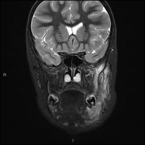 File:Chronic reactive multifocal osteomyelitis (CRMO) - mandible (Radiopaedia 56405-63069 Coronal STIR 15).jpg