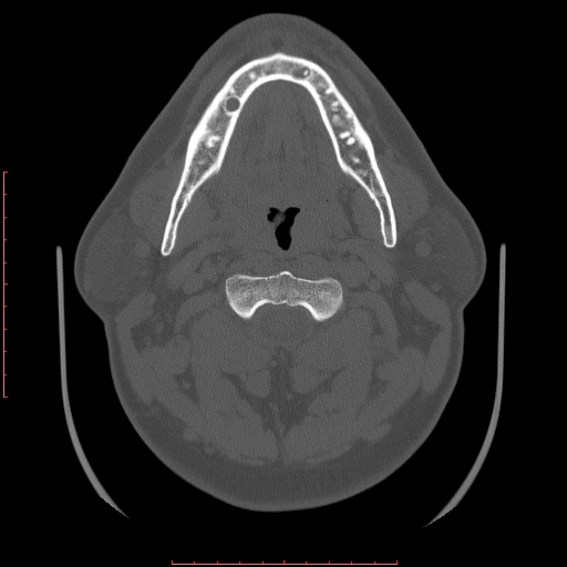 Chronic submandibular sialolithiasis (Radiopaedia 69817-79814 Axial bone window 54).jpg