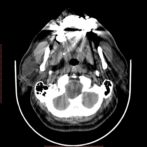 Chronic submandibular sialolithiasis (Radiopaedia 69817-79814 Axial non-contrast 46).jpg
