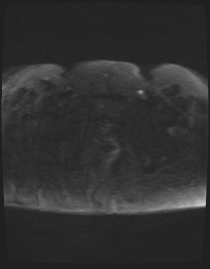 Class II Mullerian duct anomaly- unicornuate uterus with rudimentary horn and non-communicating cavity (Radiopaedia 39441-41755 Axial DWI 90).jpg