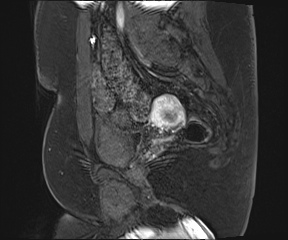 File:Class II Mullerian duct anomaly- unicornuate uterus with rudimentary horn and non-communicating cavity (Radiopaedia 39441-41755 G 75).jpg