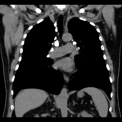 Classic complicated silicosis (Radiopaedia 49720-54961 Coronal liver window 32).jpg