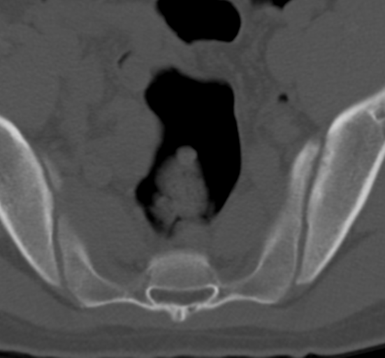 Clear cell meningoma - lumbar spine (Radiopaedia 60116-67691 Axial bone window 81).png
