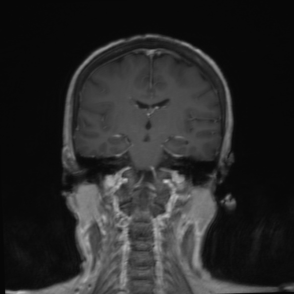 File:Clival meningioma (Radiopaedia 53278-59248 F 16).jpg